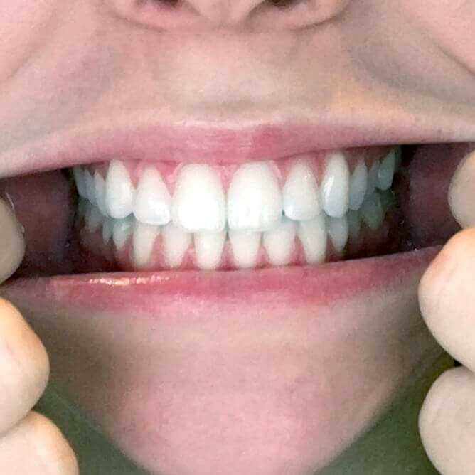 VC Over Bite Wheeler Orthodontics