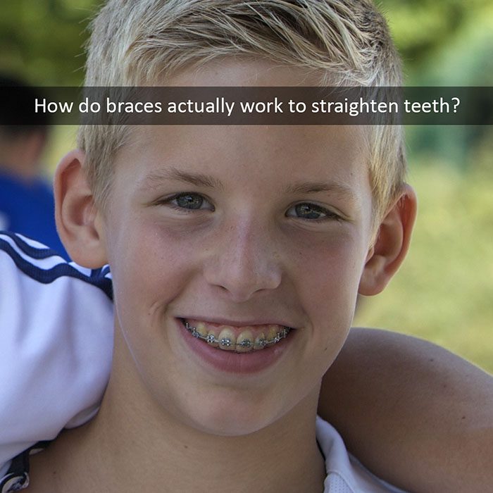 how braces work 2022 700 Wheeler Orthodontics