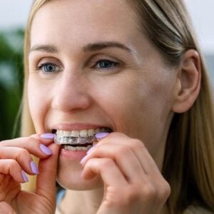 ClearCorrect aligners