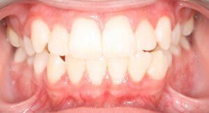 Smile transformation - Orthodontist in Toledo, OH