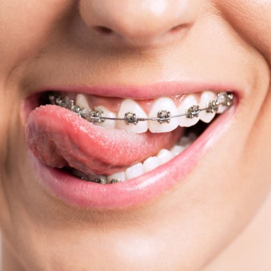 Braces in Toledo